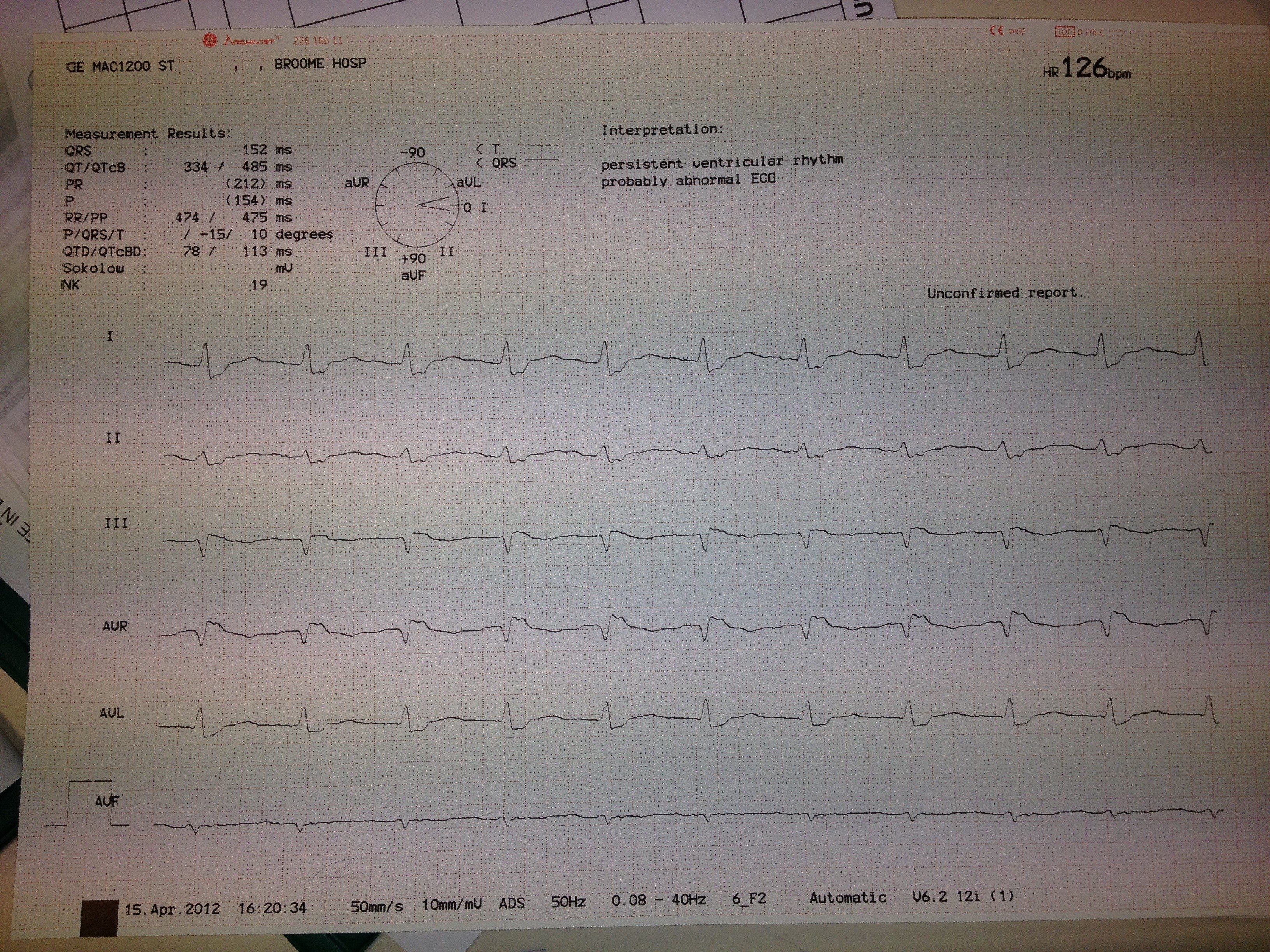 ECG1