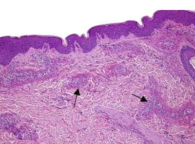 vasculitis