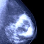 Mammogram_showing_a__20540s