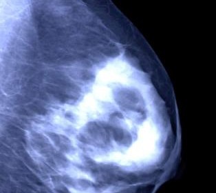 Mammogram_showing_a__20540s