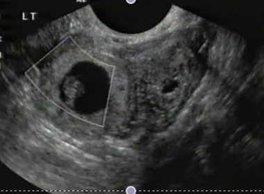 ectopic