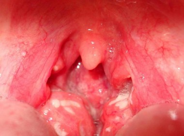 inflamed-tonsils