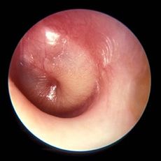 230px-Acute_Otitis_Media