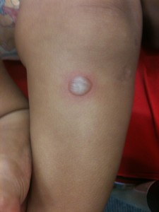 lg rash