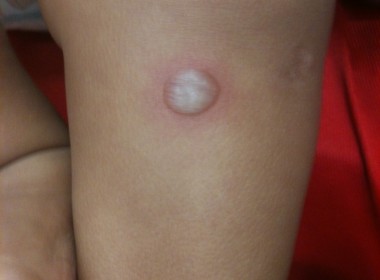 lg rash