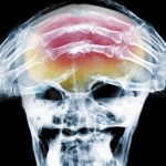 X-ray-of-headache-001