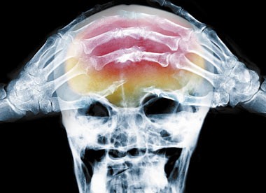 X-ray-of-headache-001