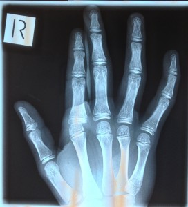 Hand MCPdlap