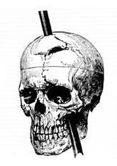 Phineas_gage_-_1868_skull_diagram