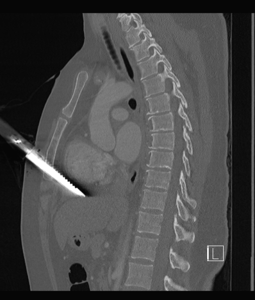 stab CT