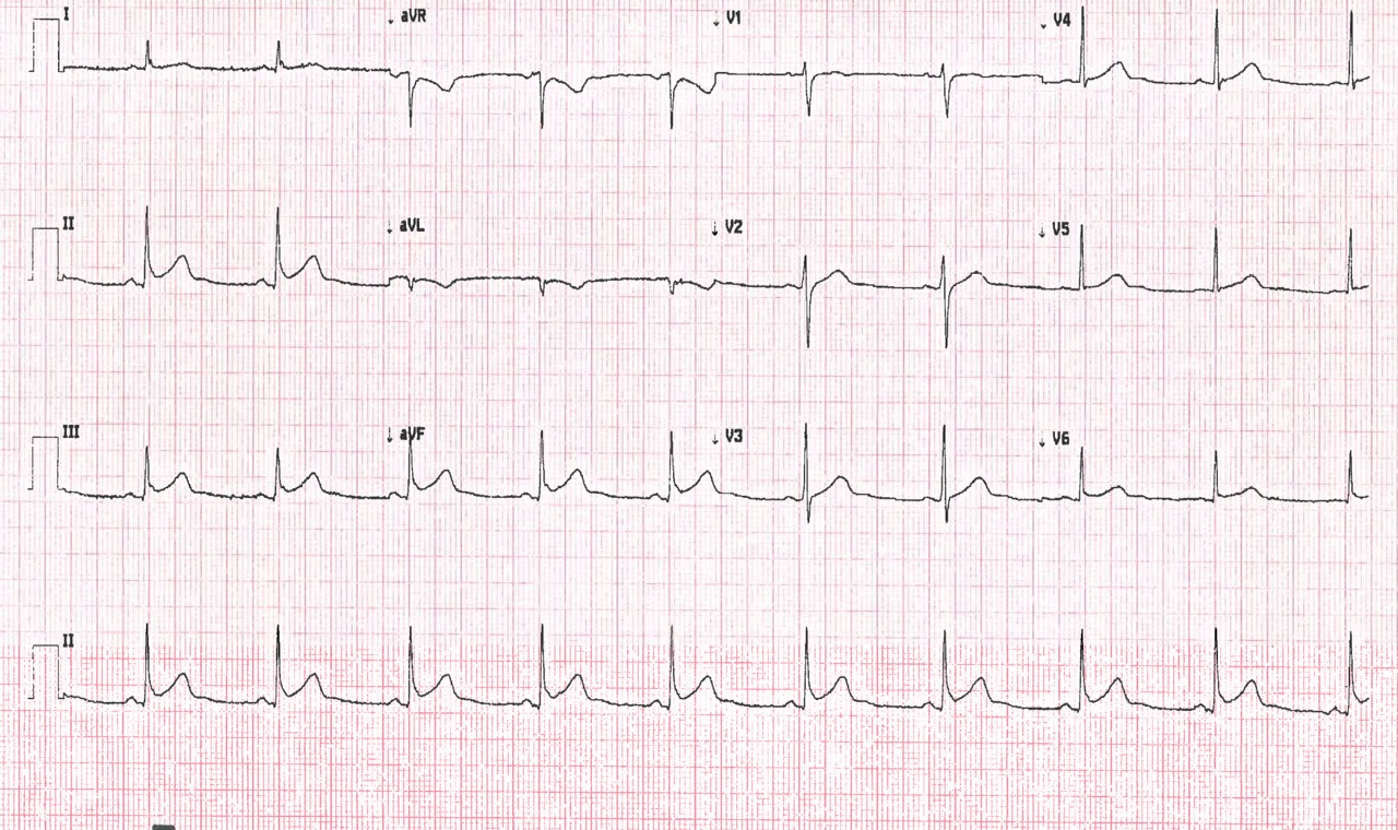 stab ECG