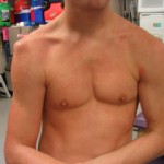 shoulder dislocation