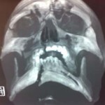 jaw-fracture