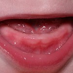 Teething