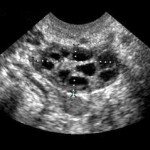 pcos_us