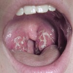 strept throat