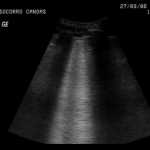 Lung_Contusion