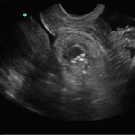 Another look at the left pelvic mass